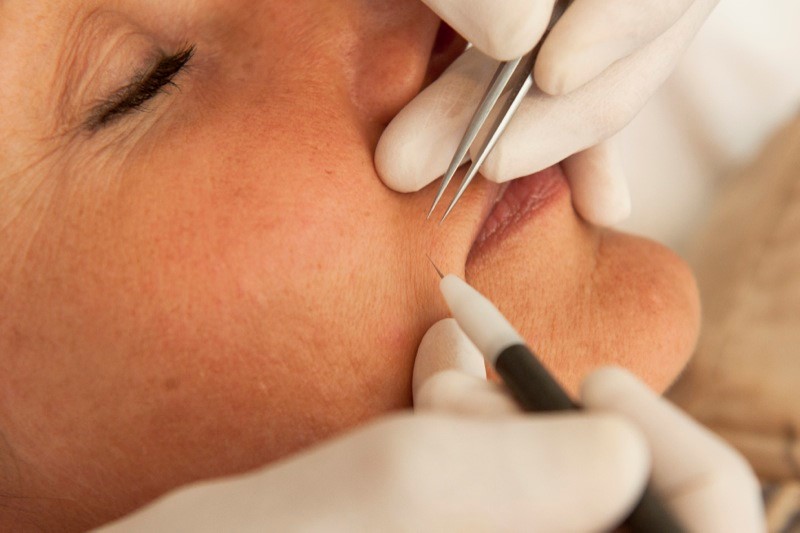 Electrolysis - Aesthetic Cosmetic Clinic in Cirencester